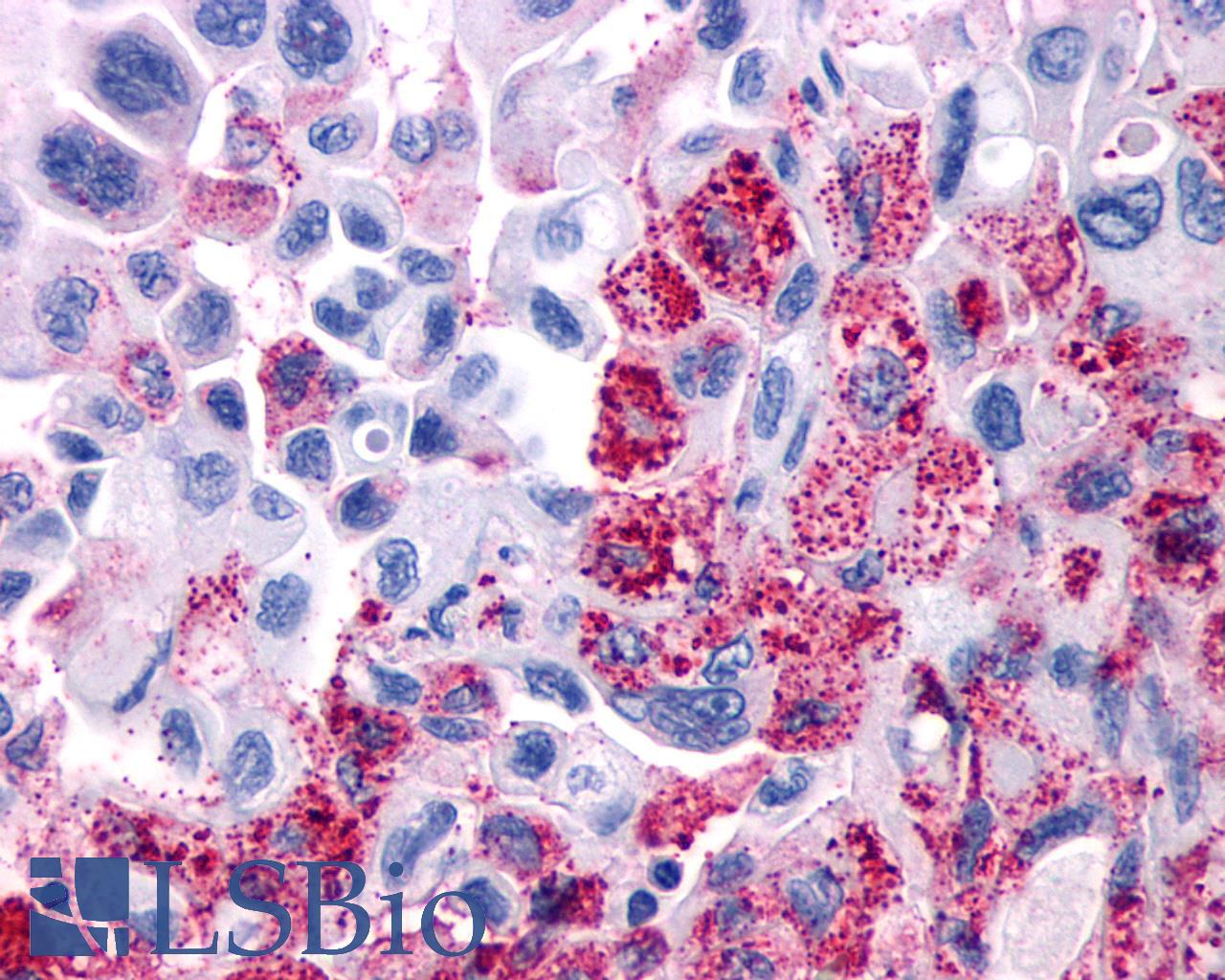 VIPR1 Antibody - Pancreas, Carcinoma