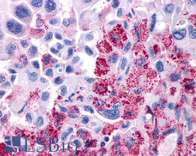 VIPR1 Antibody - Pancreas, Carcinoma