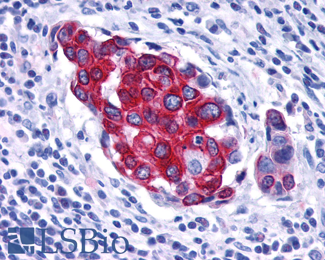 VPAC2 / VIPR2 Antibody - Breast, Carcinoma