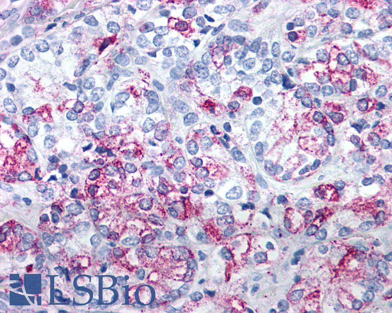 VPAC2 / VIPR2 Antibody - Prostate, Carcinoma