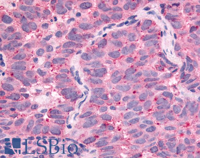WNK1 Antibody - Anti-WNK1 / p65 antibody IHC of human Lung, Non-Small Cell Carcinoma. Immunohistochemistry of formalin-fixed, paraffin-embedded tissue after heat-induced antigen retrieval.