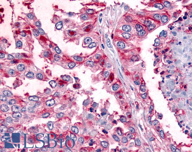 WNK1 Antibody - Lung, Non Small-Cell Carcinoma
