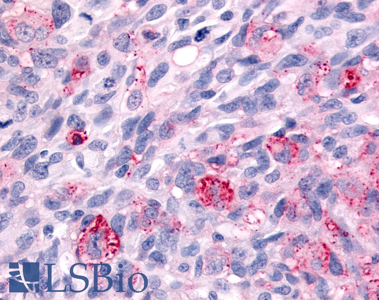 WNK1 Antibody - Brain, Glioblastoma