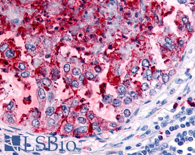 WNK1 Antibody - Lung, non small cell carcinoma