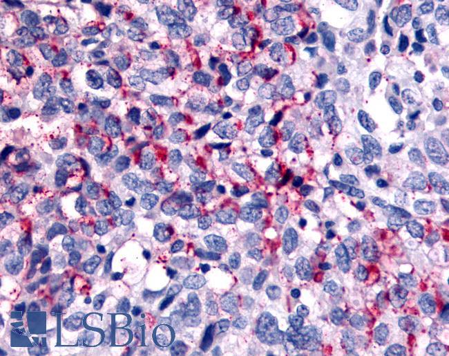 WNK1 Antibody - Ovary, carcinoma