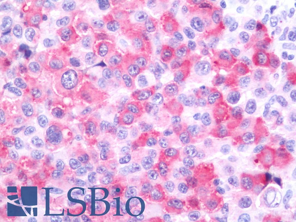 WNT10A Antibody - Human Melanoma (Lymph Node): Formalin-Fixed, Paraffin-Embedded (FFPE)