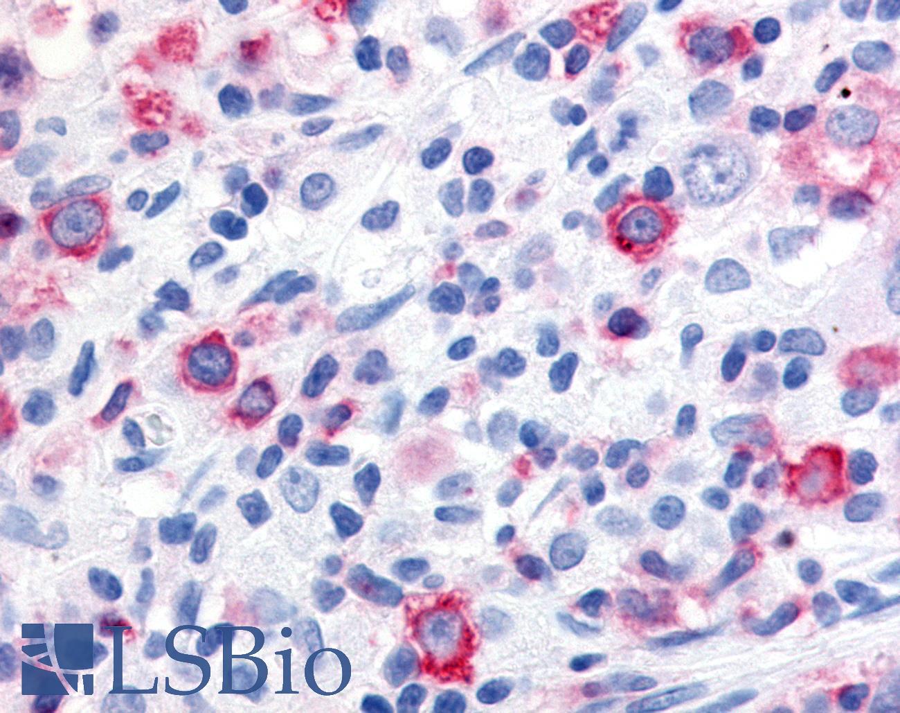 WNT10A Antibody - Non-Hodgkin's lymphoma