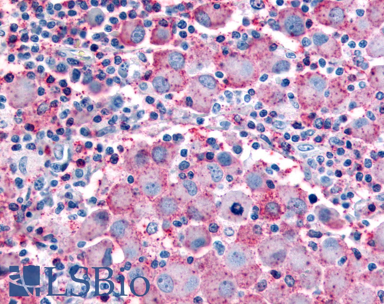 WNT10A Antibody - Skin, Malignant Melanoma