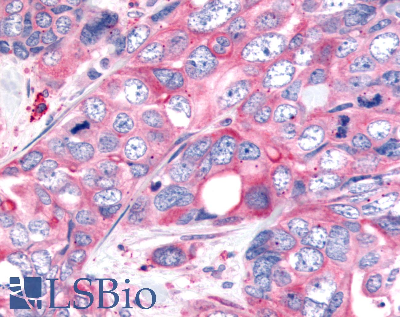 WNT8A Antibody - Anti-WNT8A antibody IHC of human Colon, Carcinoma. Immunohistochemistry of formalin-fixed, paraffin-embedded tissue after heat-induced antigen retrieval.