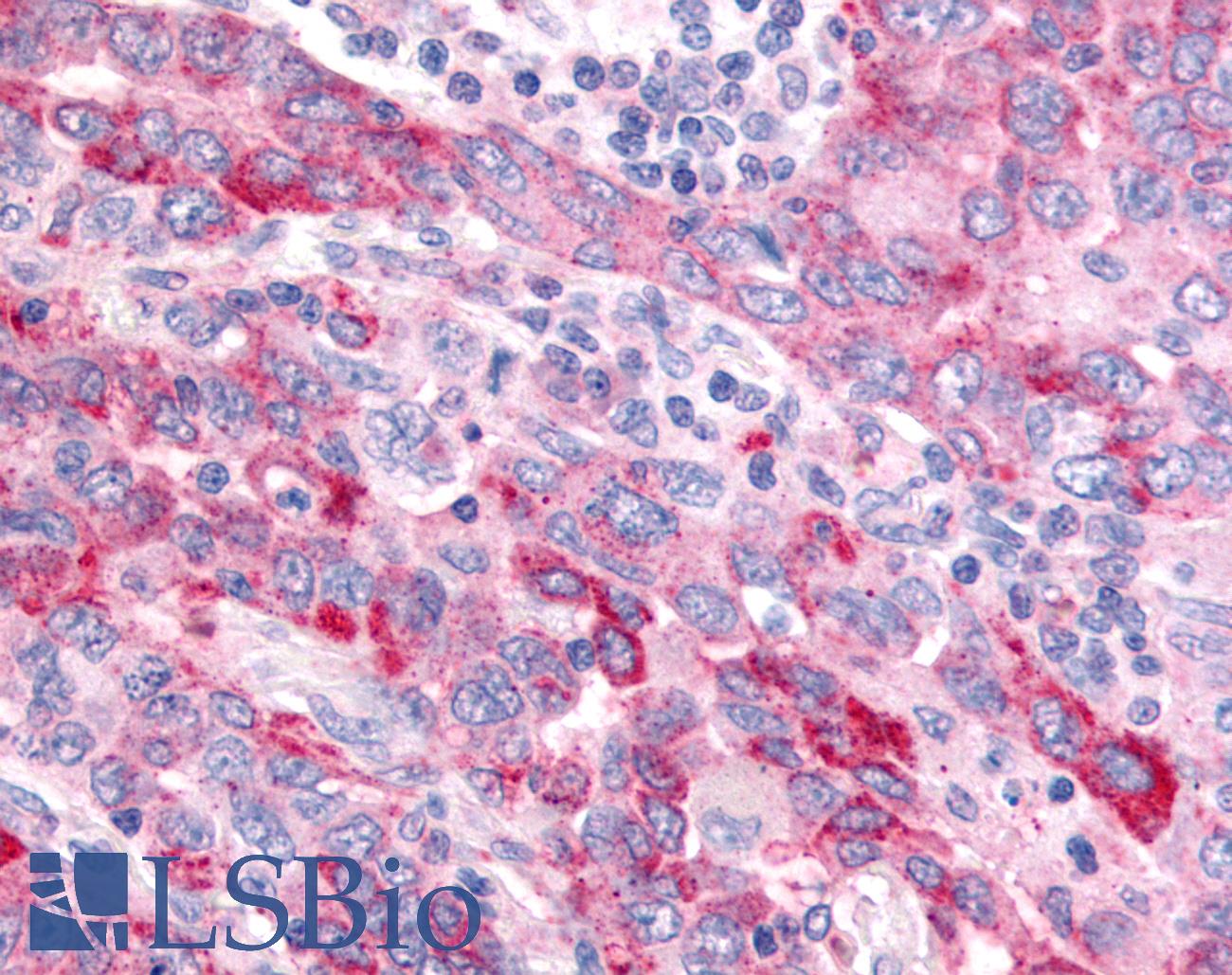 WNT8A Antibody - Anti-WNT8A antibody IHC of human Lung, Non-Small Cell Carcinoma. Immunohistochemistry of formalin-fixed, paraffin-embedded tissue after heat-induced antigen retrieval.