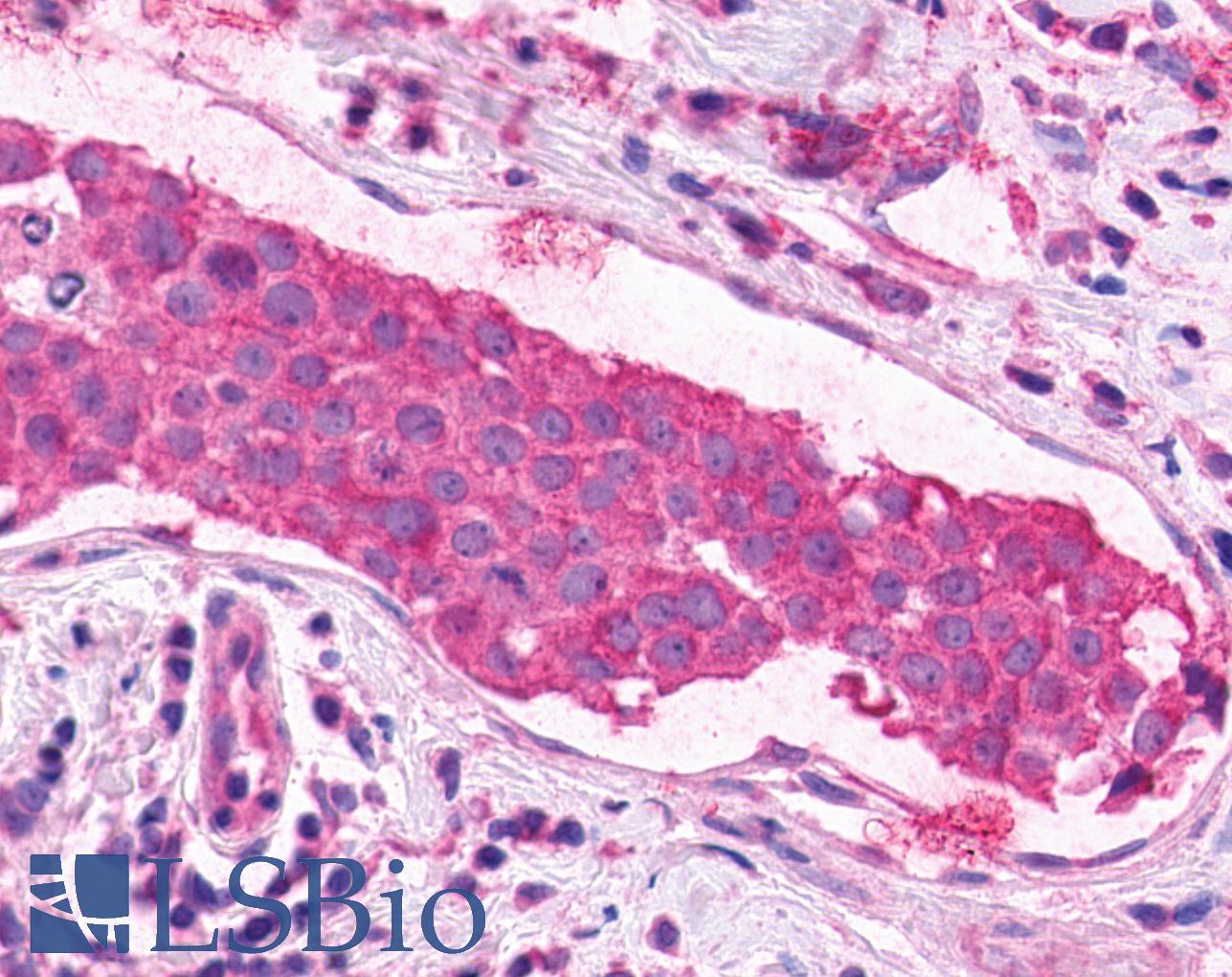XPR1 Antibody - Breast, Carcinoma