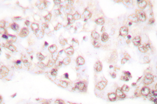 PAWR / PAR4 Antibody - IHC of Prostate Apoptosis Response protein-4 (D313) pAb in paraffin-embedded human lung carcinoma tissue.