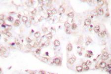 PAWR / PAR4 Antibody - IHC of Prostate Apoptosis Response protein-4 (D313) pAb in paraffin-embedded human lung carcinoma tissue.