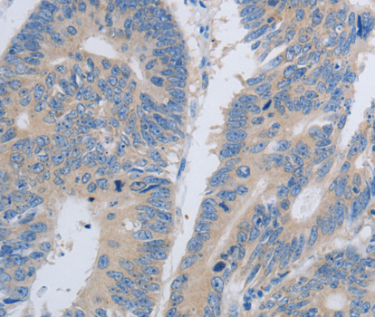 PAWR / PAR4 Antibody - Immunohistochemistry of paraffin-embedded human colon cancer tissue.