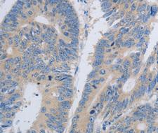 PAWR / PAR4 Antibody - Immunohistochemistry of paraffin-embedded human colon cancer tissue.