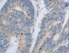 PAWR / PAR4 Antibody - Immunohistochemistry of paraffin-embedded Human colon cancer using PAWR Polyclonal Antibody at dilution of 1:60.