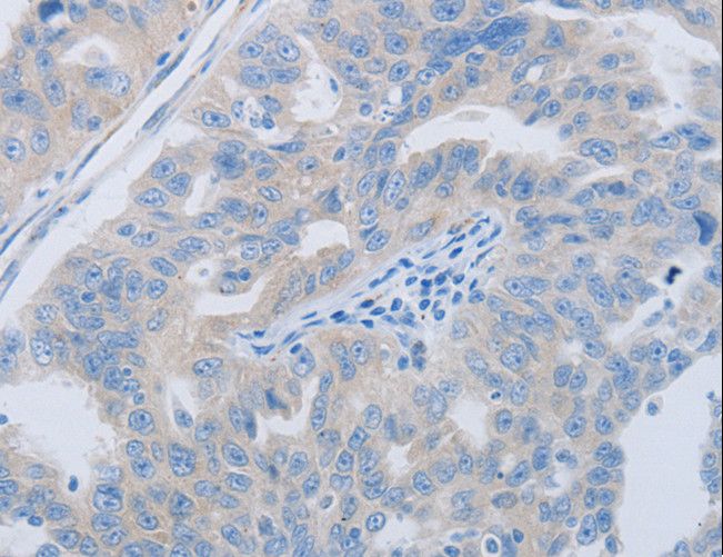 PAWR / PAR4 Antibody - Immunohistochemistry of paraffin-embedded Human ovarian cancer using PAWR Polyclonal Antibody at dilution of 1:60.