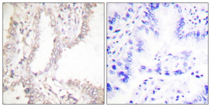 PAWR / PAR4 Antibody - Peptide - + Immunohistochemical analysis of paraffin-embedded human lung carcinoma tissue using Prostate Apoptosis Response Protein-4 antibody.