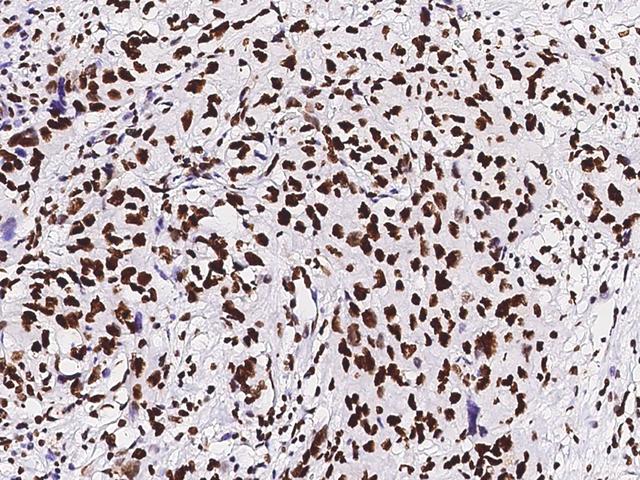 PAX2 Antibody - Immunochemical staining of human PAX2 in human renal carcinoma with rabbit polyclonal antibody at 1:1000 dilution, formalin-fixed paraffin embedded sections.