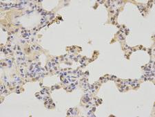 PAX3 Antibody - Immunohistochemistry of paraffin-embedded human lung cancer using PAX3 antibody at dilution of 1:200 (400x lens).