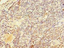 PAX3 Antibody - Immunohistochemistry of paraffin-embedded human lung cancer using PAX3 Antibody at dilution of 1:100