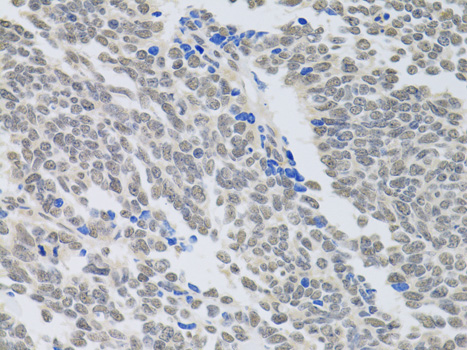 PAX3 Antibody - Immunohistochemistry of paraffin-embedded human lung cancer using PAX3 antibody at dilution of 1:100 (40x lens).