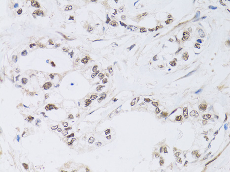 PAX3 Antibody - Immunohistochemistry of paraffin-embedded human gastric cancer using PAX3 antibody at dilution of 1:100 (40x lens).
