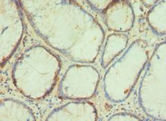 PAX4 Antibody - Immunohistochemistry of paraffin-embedded human colorectal carcinoma using antibody at 1:100 dilution.
