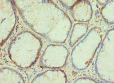 PAX4 Antibody - Immunohistochemistry of paraffin-embedded human colorectal carcinoma using antibody at 1:100 dilution.