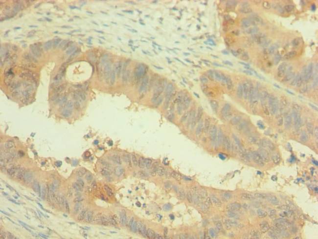 PAX4 Antibody - Immunohistochemistry of paraffin-embedded human colon cancer using PAX4 Antibody at dilution of 1:100
