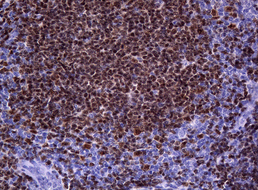 PAX5 Antibody - Immunohistochemical staining of paraffin-embedded Human lymphoma tissue using anti-PAX5 mouse monoclonal antibody. (Heat-induced epitope retrieval by 1mM EDTA in 10mM Tris buffer. (pH8.0) at 120°C for 3 min. (1:200)