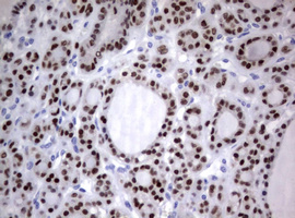 PAX5 Antibody - IHC of paraffin-embedded Carcinoma of Human thyroid tissue using anti-PAX5 mouse monoclonal antibody.