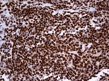 PAX5 Antibody - IHC of paraffin-embedded Human lymphoma tissue using anti-PAX5 mouse monoclonal antibody. (Heat-induced epitope retrieval by 10mM citric buffer, pH6.0, 120°C for 3min).