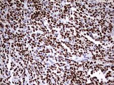 PAX5 Antibody - IHC of paraffin-embedded Human lymphoma tissue using anti-PAX5 mouse monoclonal antibody. (Heat-induced epitope retrieval by 10mM citric buffer, pH6.0, 120°C for 3min).