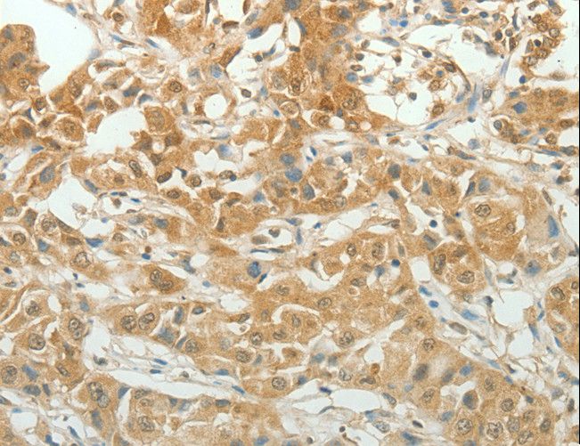 PAX5 Antibody - Immunohistochemistry of paraffin-embedded Human lung cancer using PAX5 Polyclonal Antibody at dilution of 1:20.