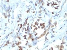 PAX6 Antibody - Formalin-fixed, paraffin-embedded human gastric carcinoma stained with PAX6 antibody (PAX6/1166).  This image was taken for the unmodified form of this product. Other forms have not been tested.