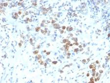 PAX6 Antibody - Formalin-fixed, paraffin-embedded human gastric carcinoma stained with PAX-6 antibody (SPM612).  This image was taken for the unmodified form of this product. Other forms have not been tested.