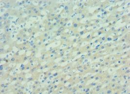 PAX7 Antibody - Immunohistochemistry of paraffin-embedded human lung cancer using antibody at 1:100 dilution.