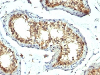 PAX7 Antibody - Formalin-fixed, paraffin-embedded human testicular carcinoma stained with PAX7 antibody (PAX7/1187).  This image was taken for the unmodified form of this product. Other forms have not been tested.