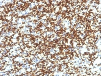 PAX7 Antibody - Formalin-fixed, paraffin-embedded human Rhabdomyosarcoma stained with PAX7 antibody (PAX7/1187).  This image was taken for the unmodified form of this product. Other forms have not been tested.