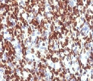 PAX7 Antibody - FFPE human Rhabdomyosarcoma stained with PAX7 antibody (clone PBPX7).  This image was taken for the unmodified form of this product. Other forms have not been tested.