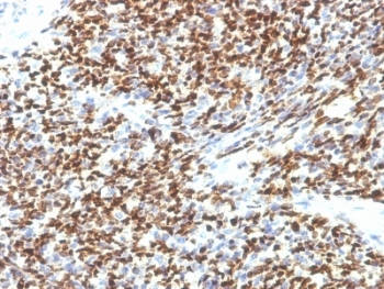 PAX7 Antibody - Formalin-fixed, paraffin-embedded human Rhabdomyosarcoma stained with PAX-7 antibody (SPM613).  This image was taken for the unmodified form of this product. Other forms have not been tested.