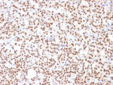 PAX8 Antibody - IHC testing of FFPE human thyroid carcinoma with PAX8 antibody (clone PAX8/1492). Required HIER: boil tissue sections in 10mM Tris buffer with 1mM EDTA, pH 9, for 10-20 min followed by cooling at RT for 20 minutes.