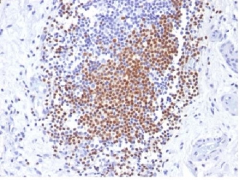 PAX8 Antibody - IHC testing of FFPE human urothelial carcinoma with PAX8 antibody (clone PAX8/1492). Required HIER: boil tissue sections in 10mM Tris buffer with 1mM EDTA, pH 9, for 10-20 min followed by cooling at RT for 20 minutes.