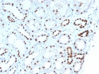 PAX8 Antibody - IHC testing of FFPE human renal cell carcinoma with PAX8 antibody (clone PAX8/1492). Required HIER: boil tissue sections in 10mM Tris buffer with 1mM EDTA, pH 9, for 10-20 min followed by cooling at RT for 20 minutes.