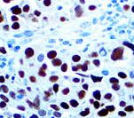 PAX8 Antibody - IHC of PAX-8 on FFPE Ovarian Carcinoma tissue.