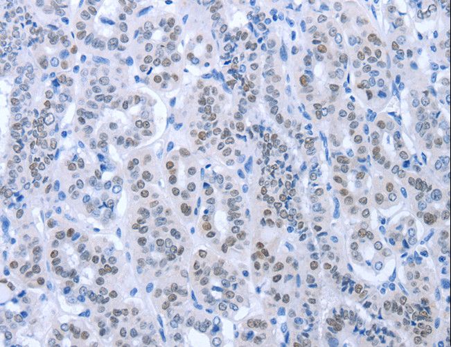 PAX8 Antibody - Immunohistochemistry of paraffin-embedded Human thyroid cancer using PAX8 Polyclonal Antibody at dilution of 1:35.