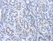 PAX8 Antibody - Immunohistochemistry of paraffin-embedded Human thyroid cancer using PAX8 Polyclonal Antibody at dilution of 1:35.