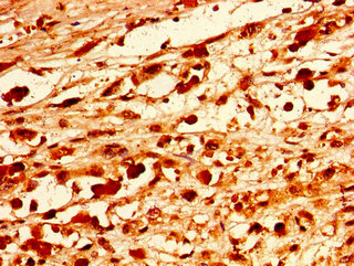 PAX9 Antibody - Immunohistochemistry image of paraffin-embedded human melanoma cancer at a dilution of 1:100