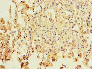 PAXIP1 / PTIP Antibody - Immunohistochemistry of paraffin-embedded human lung cancer using PAXIP1 Antibody at dilution of 1:100